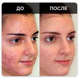 acnelocin до и после