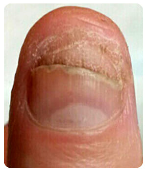 Грибок на ногтях рук до применения крема Clavosan.