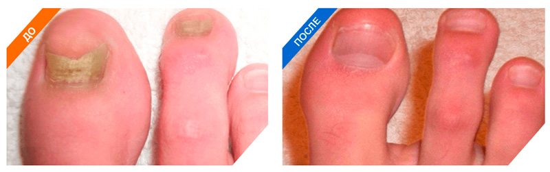 Изображения ногтей и ног до и после применения Микоцина