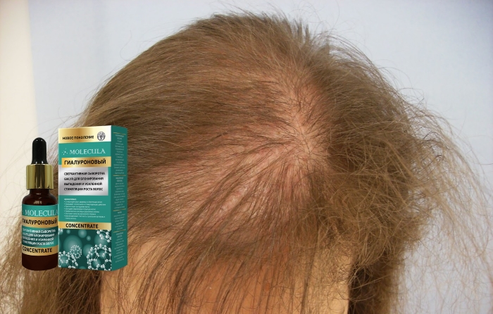 Достоинства сыворотки Gialur (Гиалур) от выпадения и для роста волос
