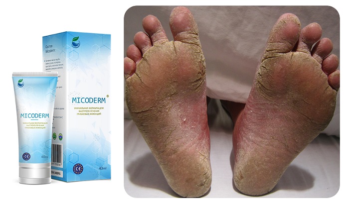 MICODERM от грибка ног и ногтей: безопасное и быстрое лечение в домашних условиях!