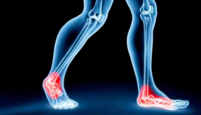Лечение суставов на ногах c помощью Сустафлекс