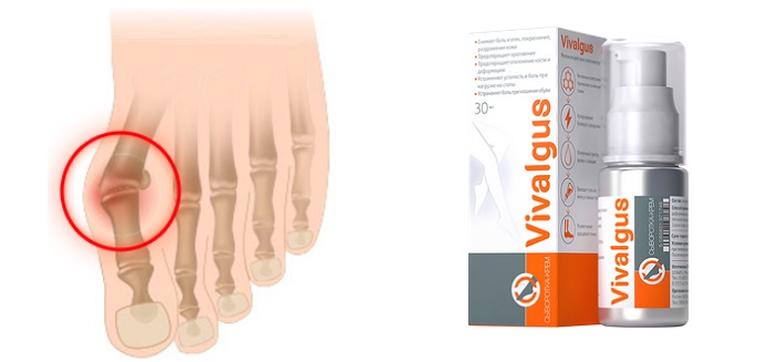 Vivalgus от косточки на ноге: эффективный способ лечения вальгуса!