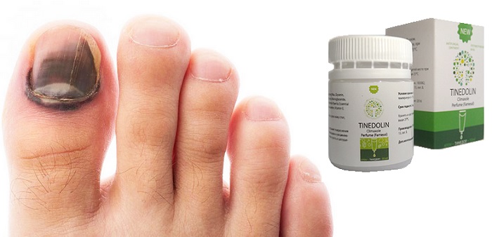 Тинедолин от грибка ног и ногтей: эффективное средство лечения микоза!